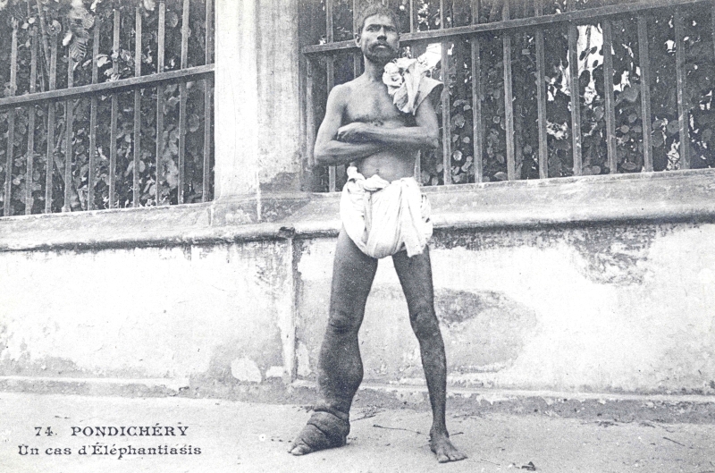 16-25 - Pondichery - homme atteint d'elephantiasis